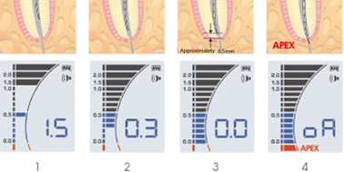 NSK IPex II – Апекслокатор