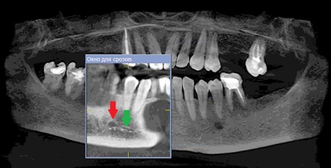 Рисунок 1а- КЛКТ. Панорамныи реформат. (Зеленая стрелка резцовая петля красная стрелка подбородочное отверстие.).jpg