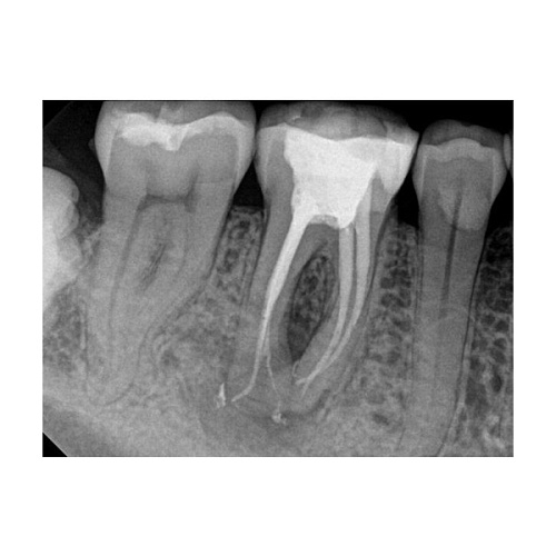 Carestream Kodak RVG 6200 - радиовизиограф