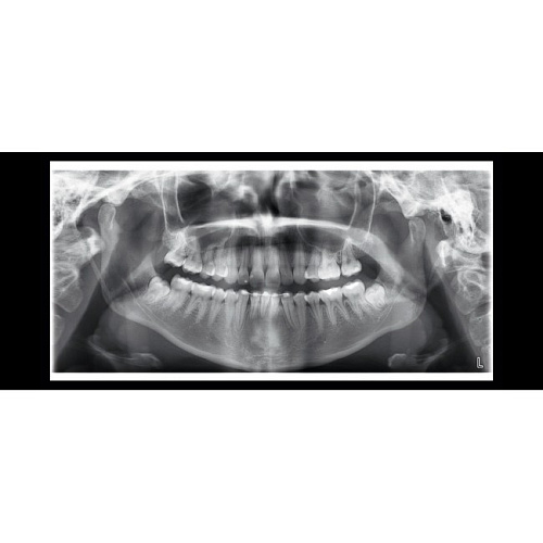 Planmeca ProOne - универсальный цифровой ортопантомограф