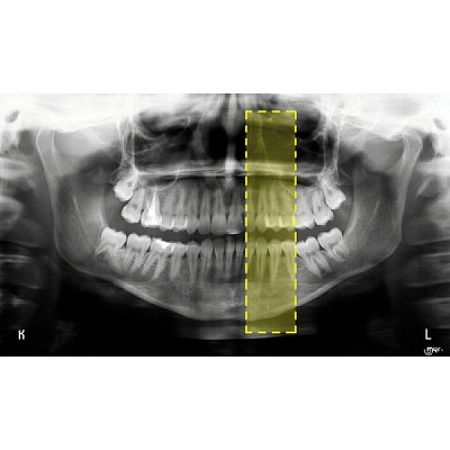 MyRay Hyperion X9 3D-READY Ceph Titanium - дентальный цифровой аппарат с цефалостатом