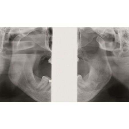 KaVo Pan eXam Plus 3D Ceph (2 датчика) - универсальный датчик Pan/Ceph для панорамной томографии, цефалостат, функция 3D-томографии 6x8 см