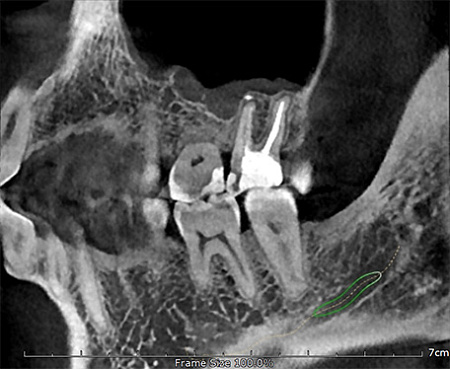 GENORAY Papaya 3D 16x14 - компьютерный томограф