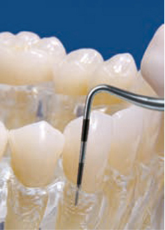 Acteon насадка для скайлера TK1-1S – короткий зонд, для осмотра и чистки карманов малой и средней глубины (менее 4 мм), (неглубокий пародонт)